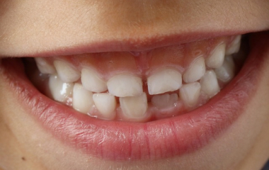 Что может послужить причиной лечения детских зубов?