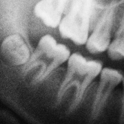 Этап Панорамный снимок челюсти (Ортопантомограмма) в Семейной стоматологии