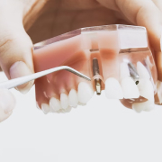 Этап Протезирование на 6 имплантах (all on 6) в Семейной стоматологии