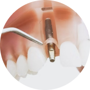 Этап Съемное протезирование зубов на имплантах в Семейной стоматологии