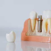 Этап Внутрикостная дентальная имплантация в Семейной стоматологии