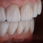 Этап Фторирование зубов в Семейной стоматологии