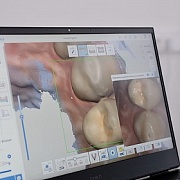 Этап Пломба на передние зубы в Семейной стоматологии