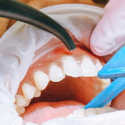 Этап Кюретаж десен в Семейной стоматологии