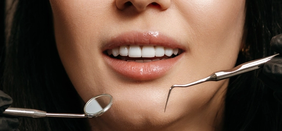 Композитные виниры