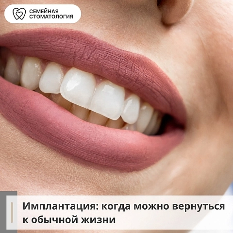 Через какое время можно возвращаться к обычной жизни после имплантации