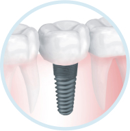 Этап Классическая имплантация зубов в Семейной стоматологии